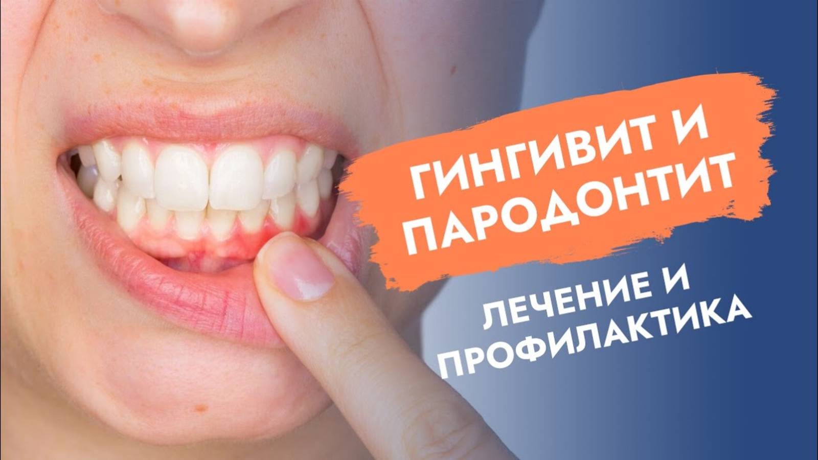 Почему гингивит излечим, а пародонтит - нет?