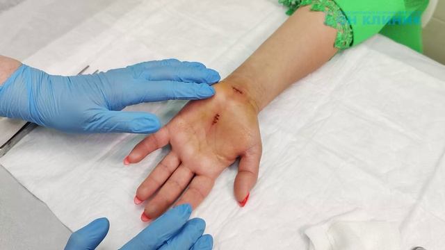 Отзыв пациентки о кистевом хирурге ОН КЛИНИК смотреть онлайн