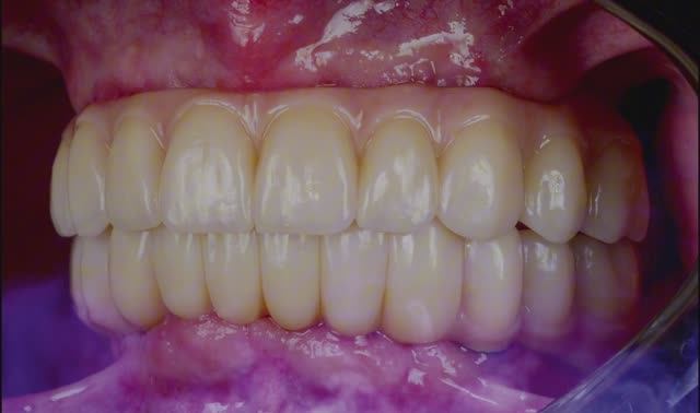 Осталось мало зубов? НЕ проблема!