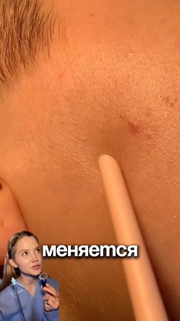 Обязательно сохрани этот способ 💁🏼♀️пилинг от акне Cosmeya:WW150990 на ВБ