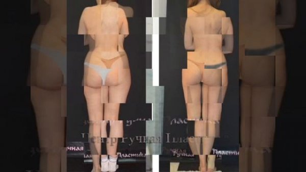 Коррекция фигуры. Ручная Пластика тела, целлюлит. 30 лет практики. Патент ruchnaya-plastika.ru