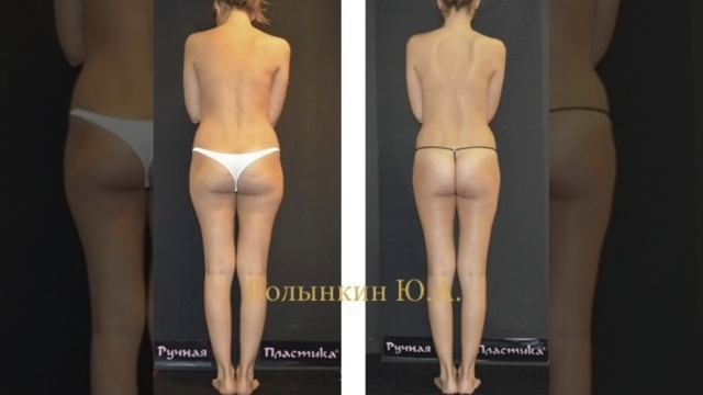Коррекция фигуры. Ручная Пластика Волынкина.  Патент. 30 лет практики.  Www.ruchnaya-plastika.ru