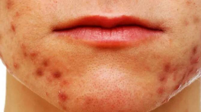 Как избавиться от прыщей смотреть онлайн