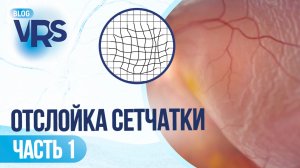 Отслойка сетчатки / часть 1