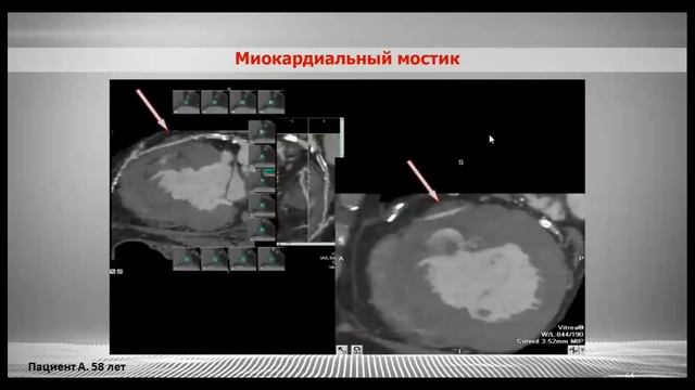 17 ЛД ИБС + ЭхоКГ смотреть онлайн