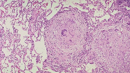 Хроническое воспаление смотреть онлайн
