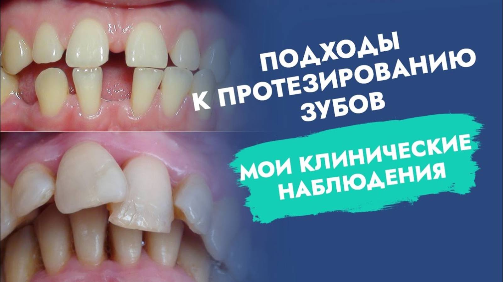 Протезировать зубы надо вовремя, иначе ...?