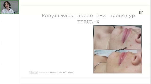 ТХА (Транексамовая кислота): новое слово в коррекции мелазмы и пвп