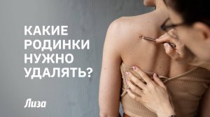 🧐ЗНАКИ НА КОЖЕ: какие РОДИНКИ могут быть ОПАСНЫ для здоровья⁉️