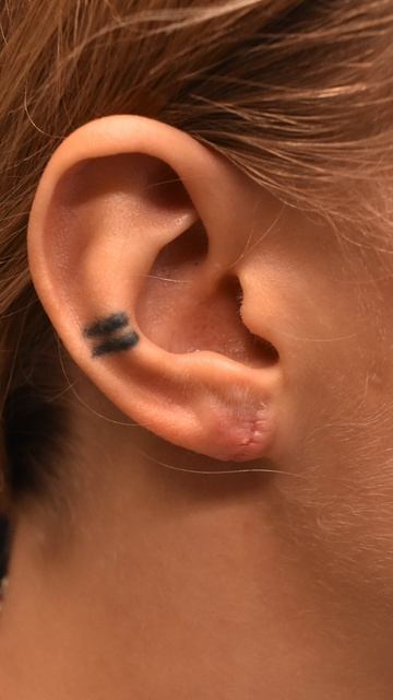 Зашивание тоннелей, реконструкция мочки и другие виды отопластики смотреть онлайн