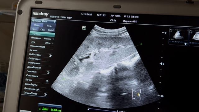 ЧТО СТАЛО С ПОЧКАМИ? #Полимиксин #Почки #узипочек #Нефрит #Антибиотики #ОРИТ #ICU