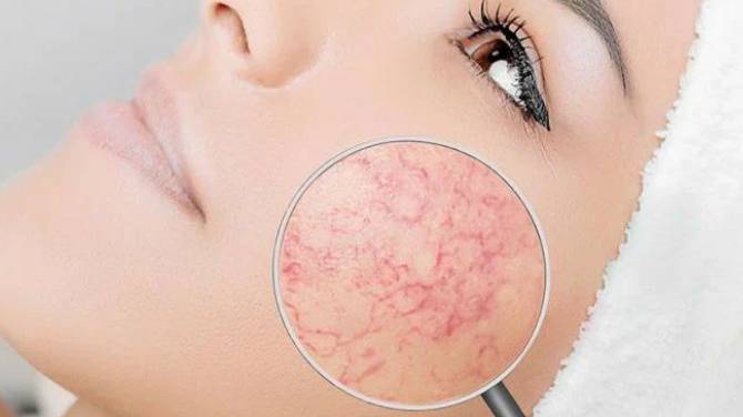 Куперозная кожа смотреть онлайн