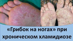 Грибок на ногах при хроническом хламидиозе