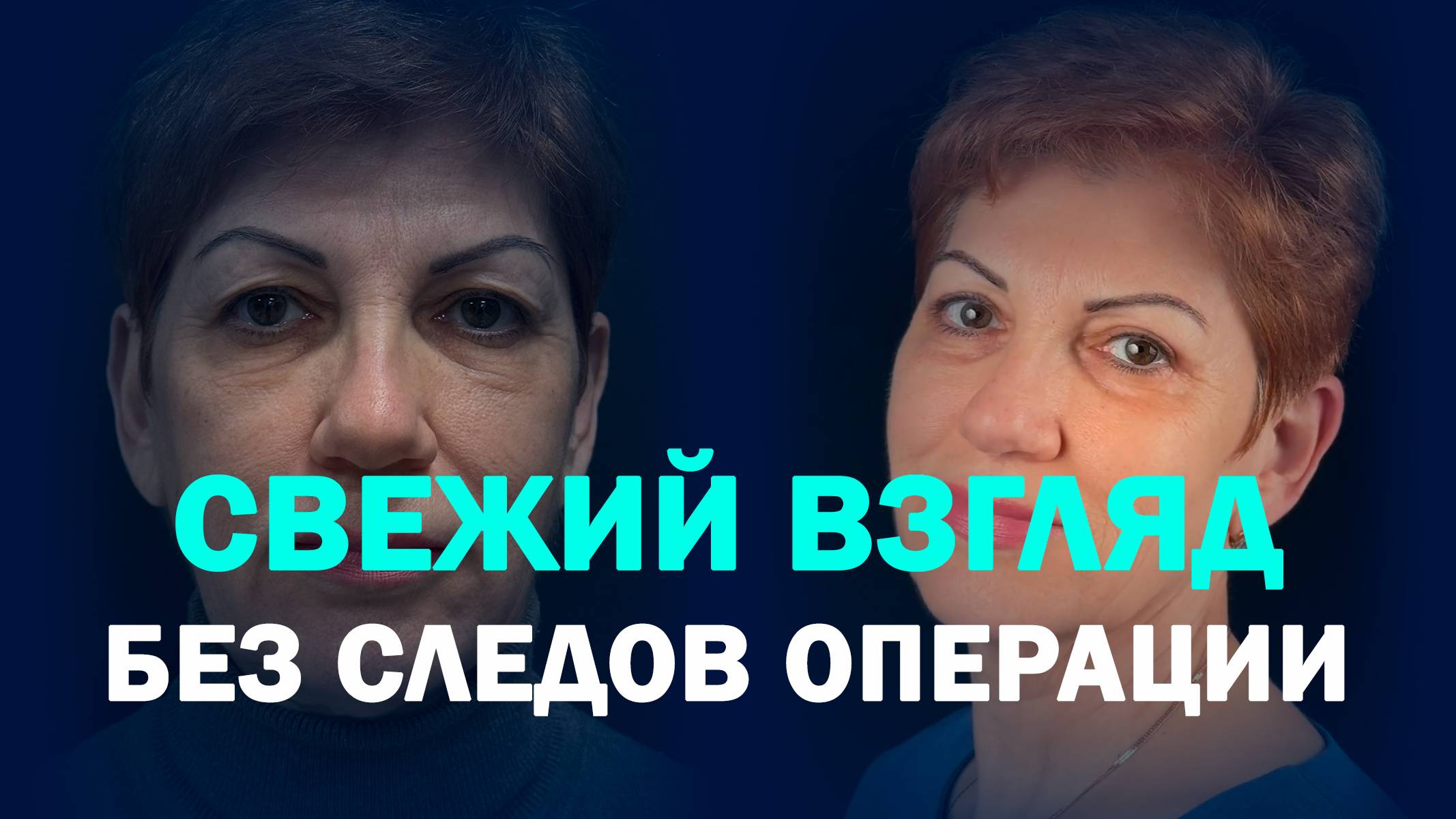 Круговая блефаропластика у доктора Галиченко: естественное омоложение без следов операции