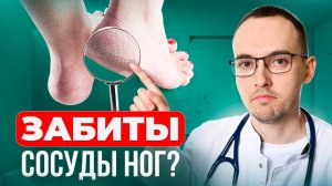 5 ПРИЗНАКОВ ЗАБИТЫХ СОСУДОВ НОГ. Как проверить дома без врача?