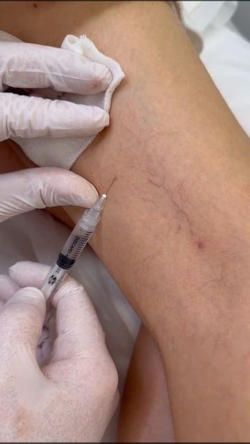 Склеротерапия: как бесследно исчезают сосудистые звёздочки! смотреть онлайн