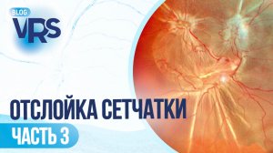 Отслойка сетчатки / часть 3