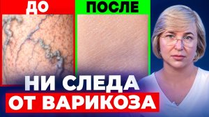 5-ти секундное действие с утра, чтобы жить без варикоза 👇