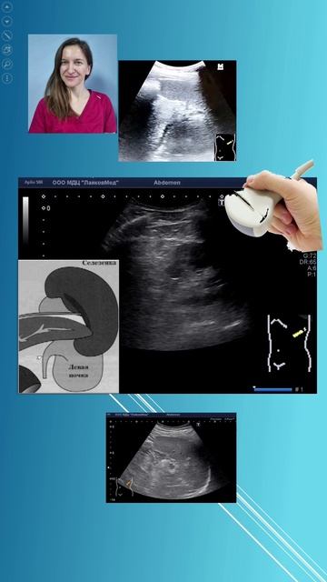 УЗИ хвоста поджелудочной железы. Баркова Елена Дмитриевна
