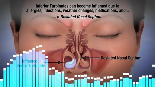 Nose Morphic Field  Deviated Septum - Clogged Sinus - Inflamed Inferior Turbinates - Nosebleeds