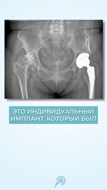 Это САМЫЙ сложный случай из ВСЕЙ моей практики! #здоровье #коксартроз #тбс смотреть онлайн
