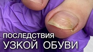 обработка вросшего ногтя