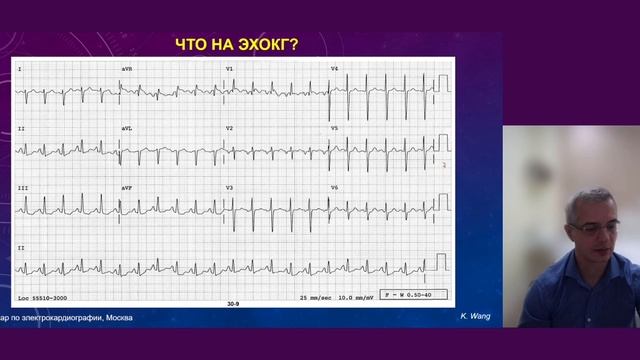 Анализ интересных ЭКГ: базовый уровень знаний