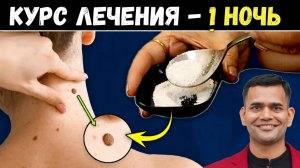 ИЗБАВЬТЕСЬ ОТ БОРОДАВОК ВСЕГО ЗА 1 НОЧЬ!