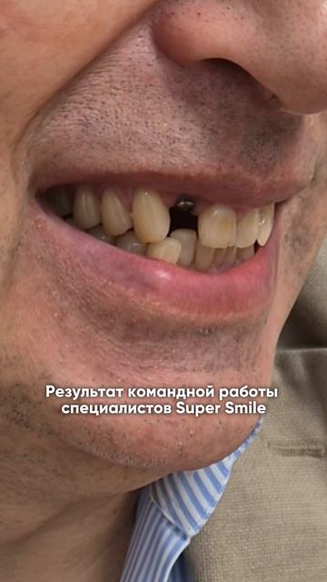 До и после имплантации зубов. Установка имплантов и коронок