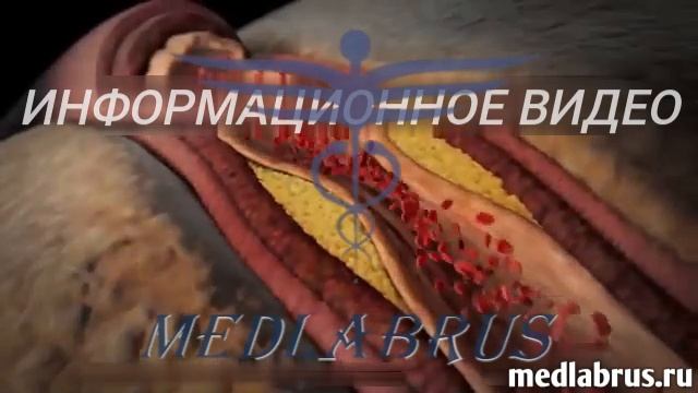 Осложнения повышенного кровяного давления (гипертонии)