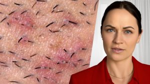 Как избавиться от вросших волос в зоне бикини и подмышек навсегда за 5 минут