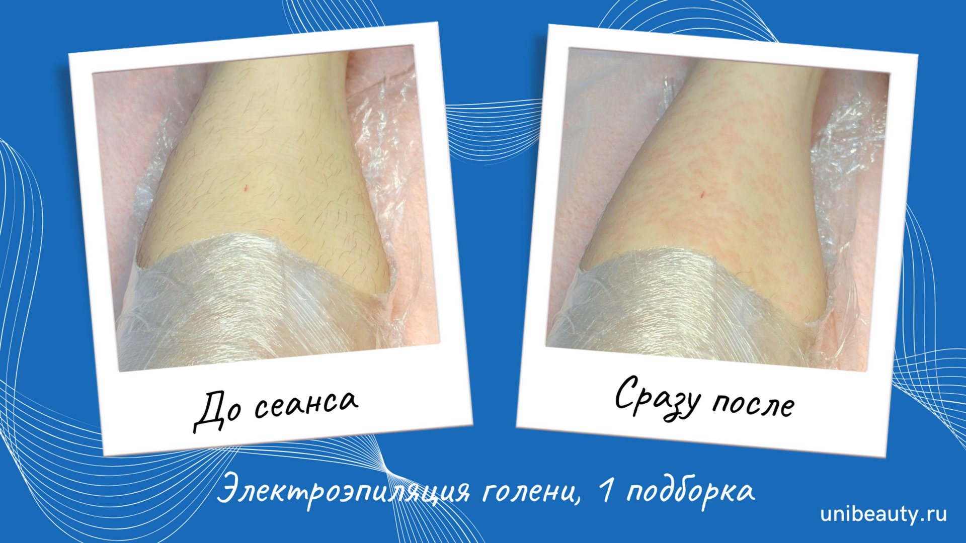 Электроэпиляция голени, 1 подборка смотреть онлайн