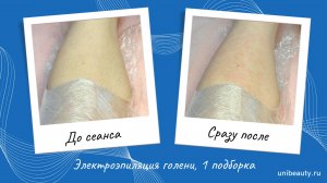 Электроэпиляция голени, 1 подборка