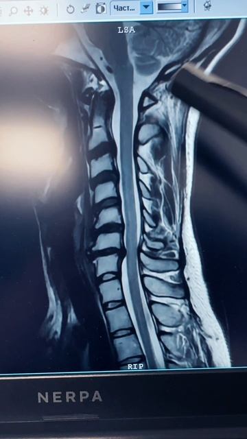 Грыжа шейного отдела позвоночника и стеноз спиномозгового канала в молодом возрасте 25 лет смотреть онлайн