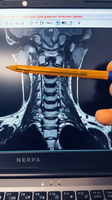 Боль в шее может быть из-за подвывиха шейных позвонков смотреть онлайн