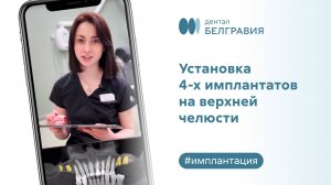 Установка 4-х имплантатов на верхней челюсти. Процесс имплантации зубов