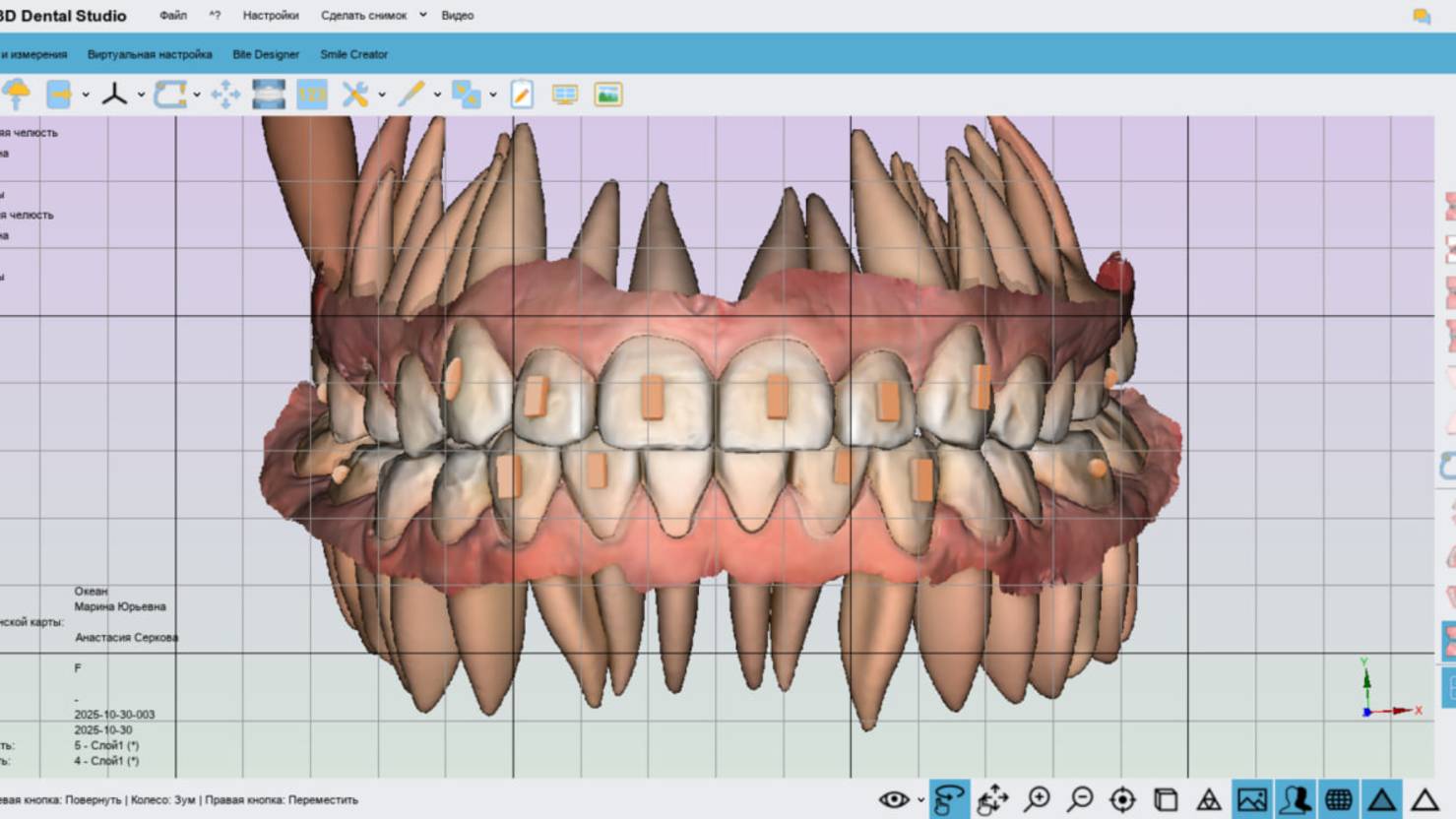 Maestro 3D. Полный цикл создания элайнеров. Кейс #1