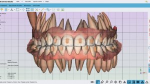 Maestro 3D. Полный цикл создания элайнеров. Кейс #1
