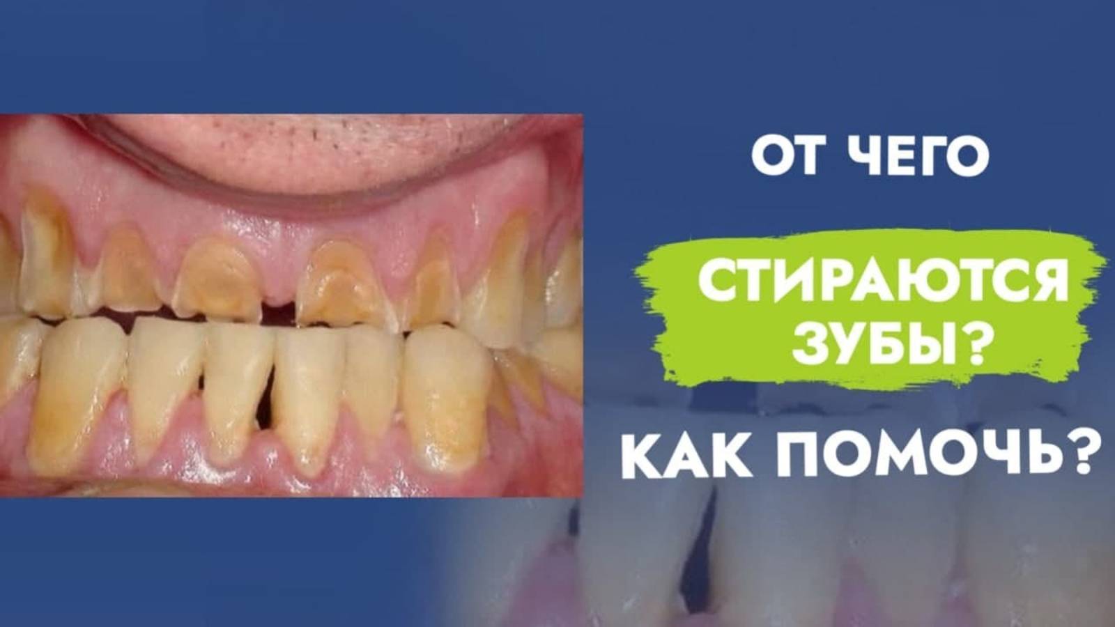 Патологическая стираемость зубов. Кому грозит и как лечить?