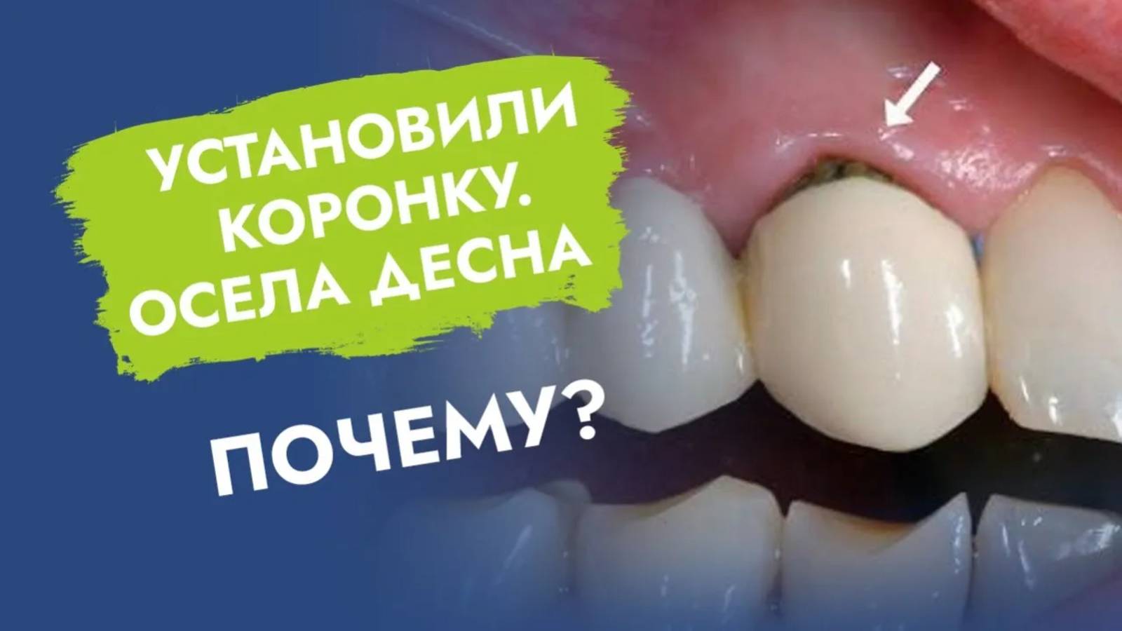 Зубная коронка стала короткой. Почему? Что делать?