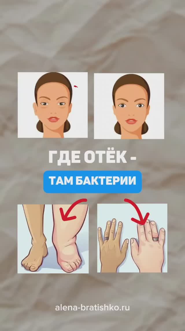 Отеки - это реакция на внедрение бактерий. Где отёк - там бактерии. Алена Братишко смотреть онлайн