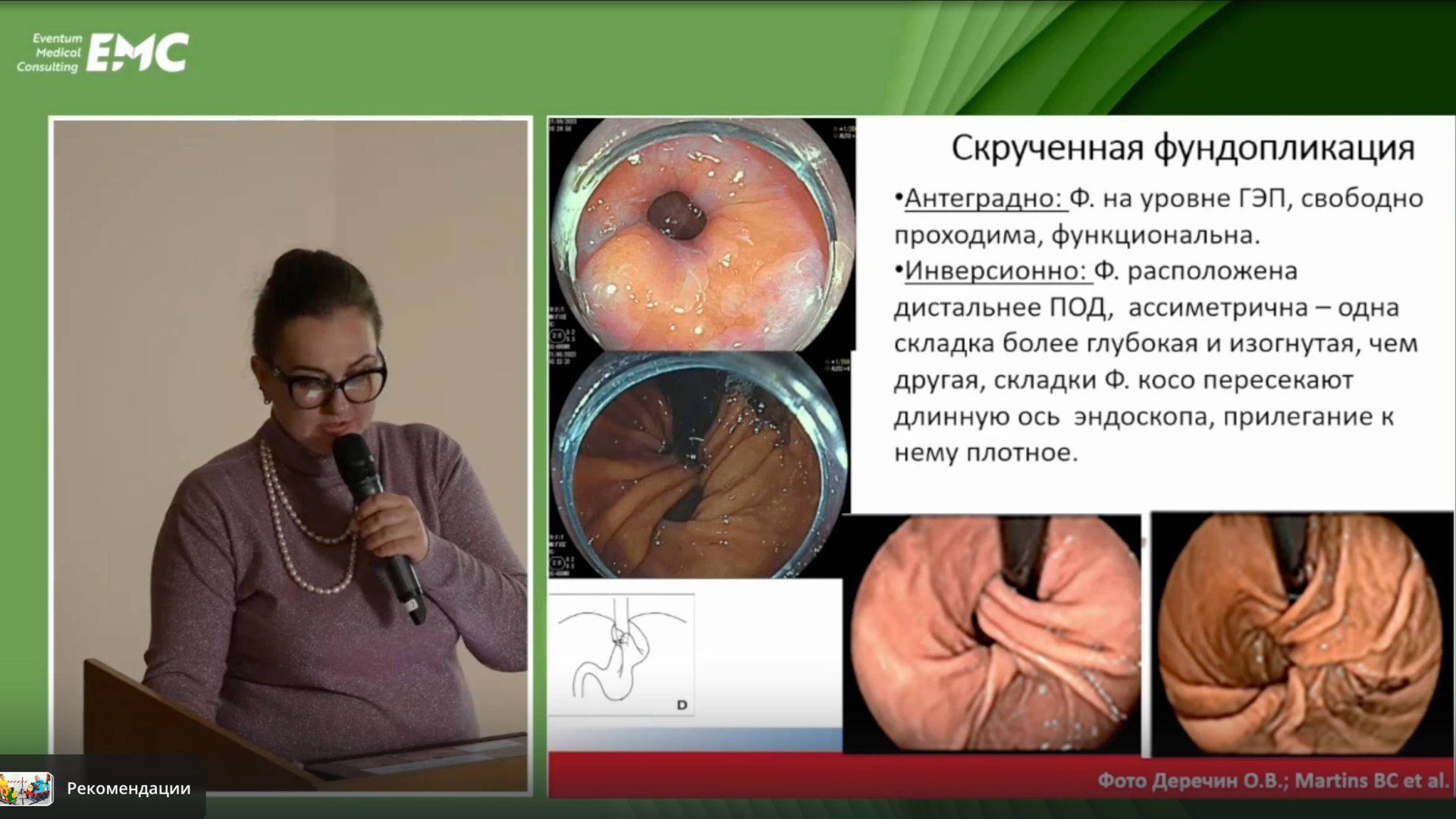 5. Аникина М.С. Эндоскопическая анатомия гастроэзофагеального перехода после фундопликации.