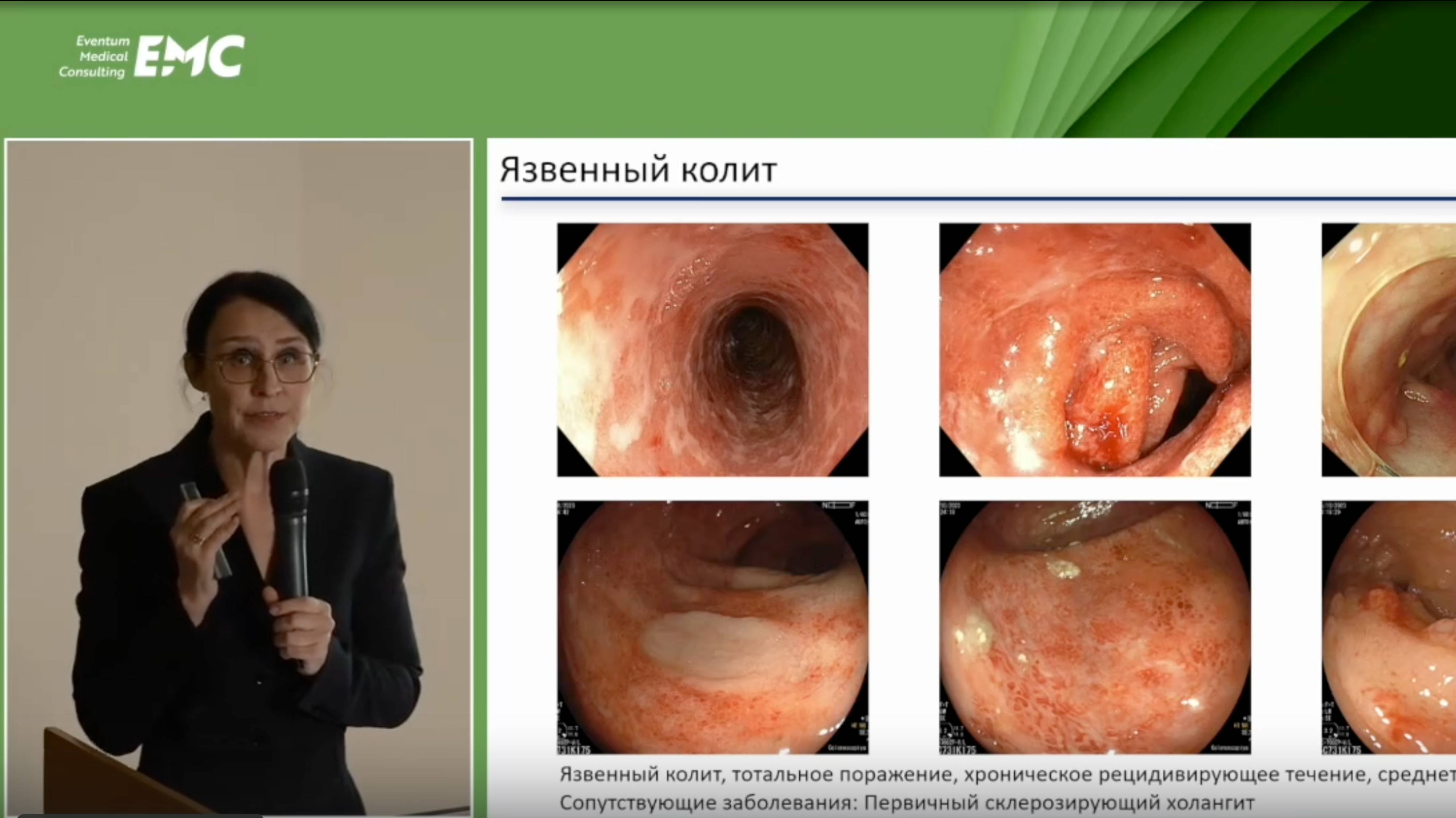 3. Вакурова Е.С. Эндоскопические аспекты диагностики ВЗК: детекция, визуализация, интерпретация.
