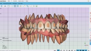Maestro 3D. Полный цикл создания элайнеров. Кейс #2. Сложный случай.
