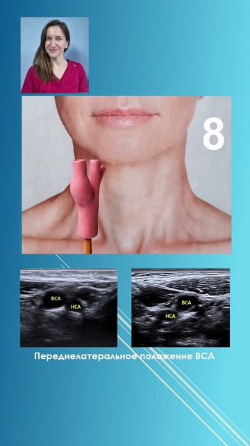 Бифуркация сонной артерии. Баркова Елена Дмитриевна