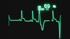 Желудочковая тахикардия / экстрасистолия