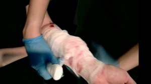 Давящая повязка бинтами