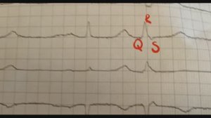 наджелудочковая экстрасистолия (предсердная)