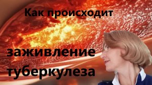 Заживление туберкулеза