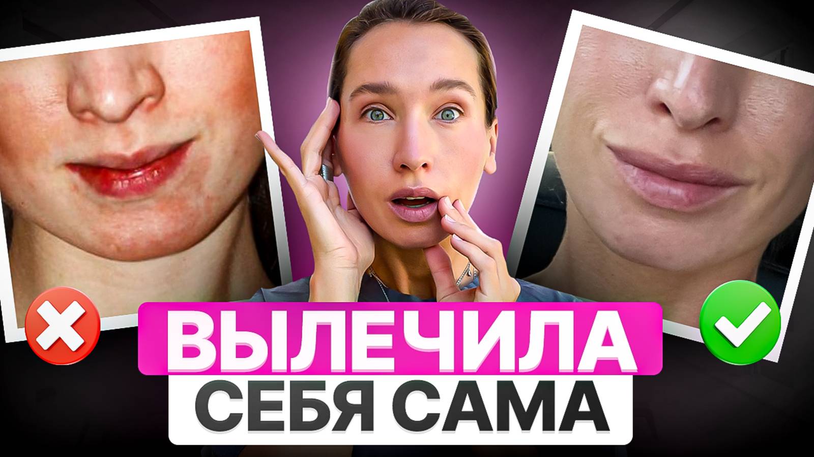 Как я спасла своё лицо? МОЯ ИСТОРИЯ лечения дерматита и анке БЕЗ косметологов и врачей смотреть онлайн